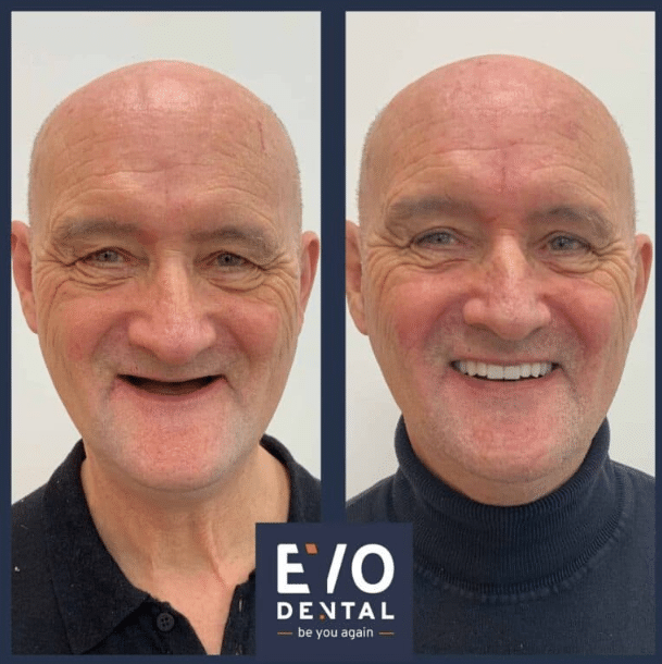 Dental Implants in Peterborogh