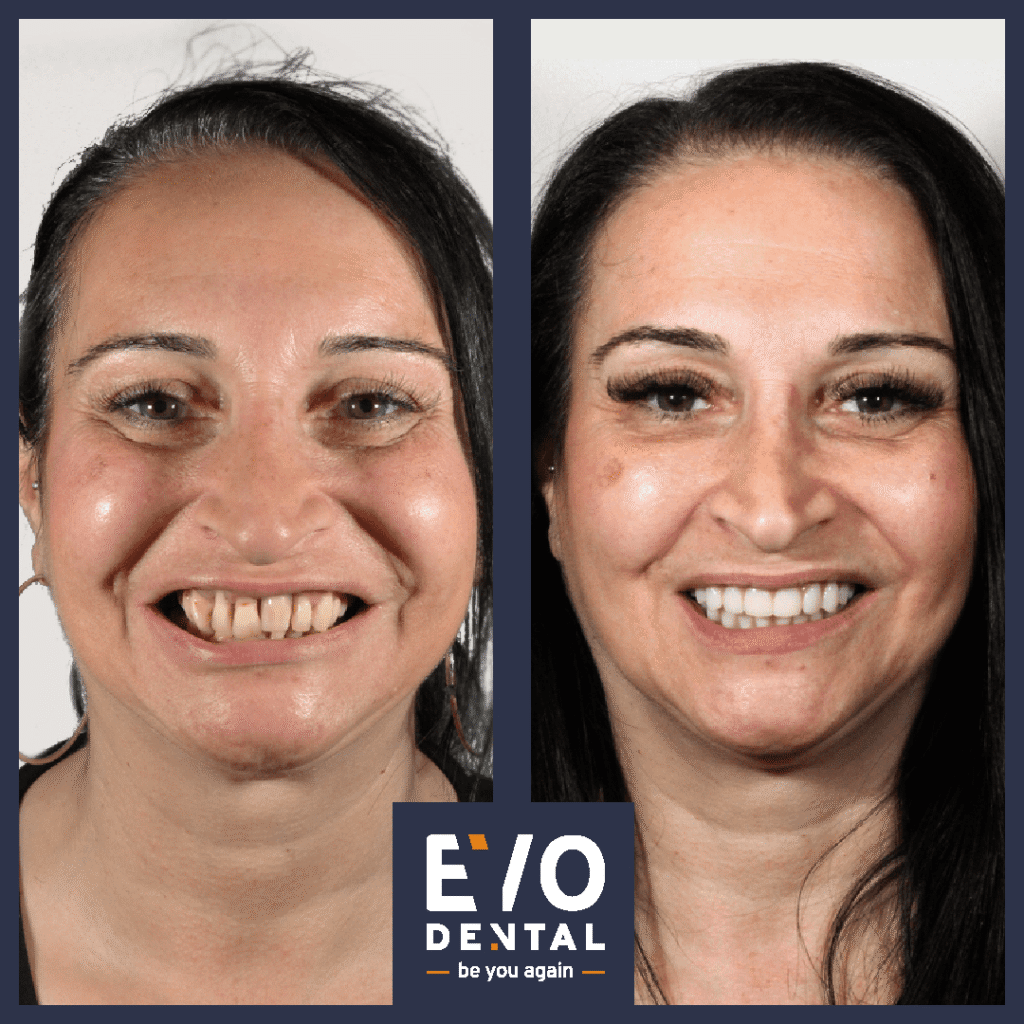 Leading Dental Implant Specialists in Nottingham