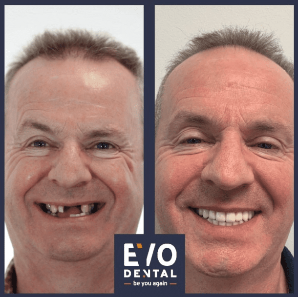 Peterborough Dental Implants