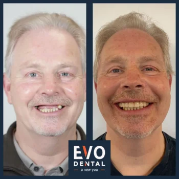 Dental implant before and after - Evo Dental Adrian