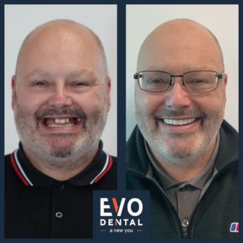 Dental implant before and after - Evo Dental Alan