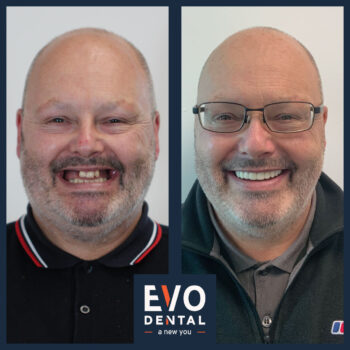 Before and after dental implants showing restored smile