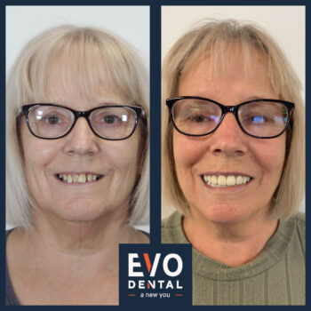 Before and after photo of dental implant procedure result