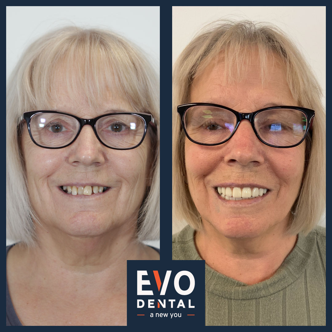 Before and after photo of dental implant procedure result