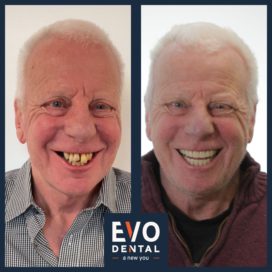 Transformation with dental implants: before and after