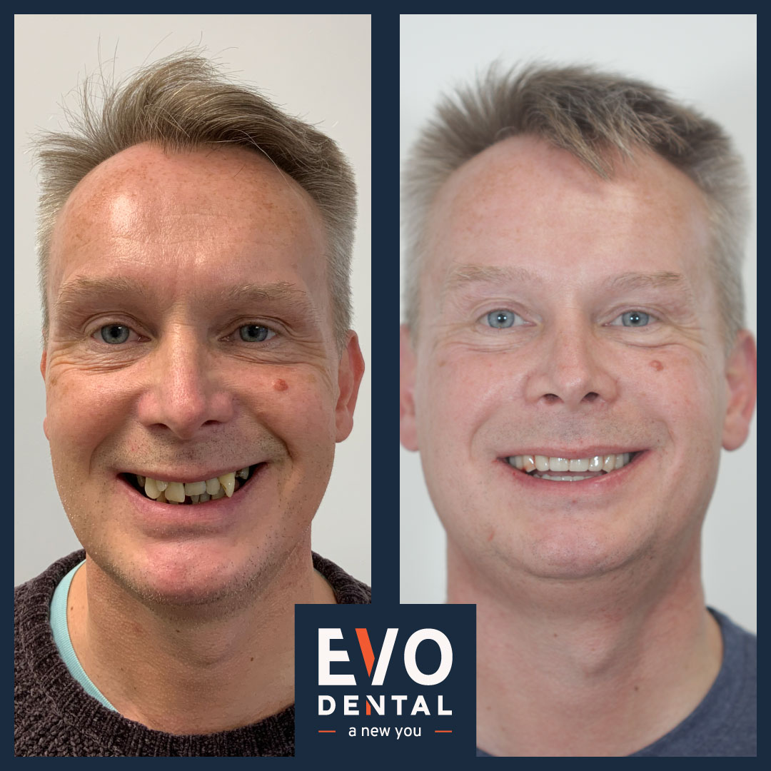 Before and after comparison of dental implant success