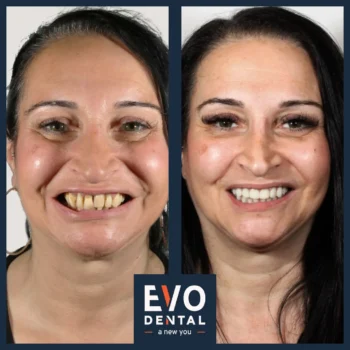 Dental implant before and after - Evo Dental Joanna