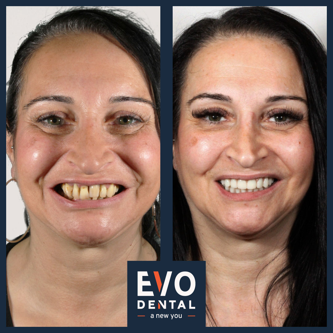 Patient’s smile transformation after dental implants