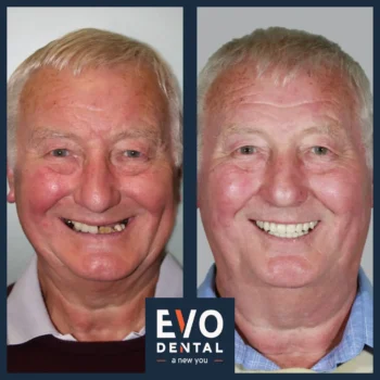 Dental implant before and after - Evo Dental John Poole