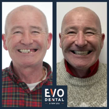 Dental implant before and after - Evo Dental John Martin
