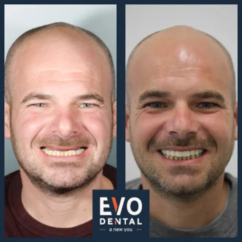 Dental implant before and after - Evo Dental Jonathan Stocks