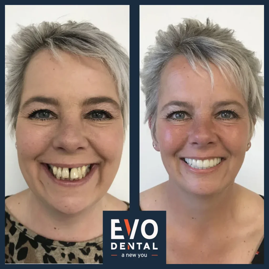 Before and after full mouth dental implant - EVO dental Kerry