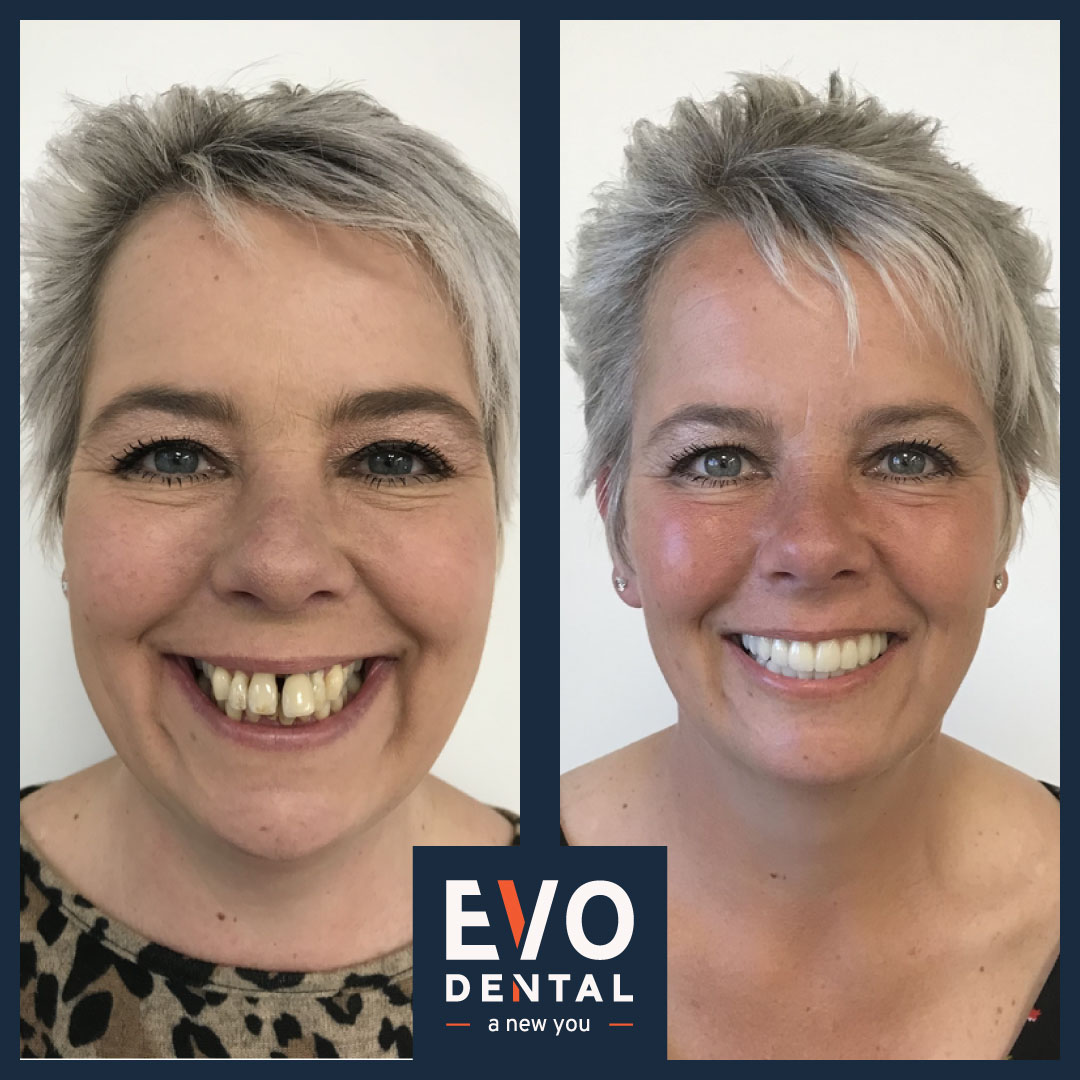 Before and after of dental implants restoring confidence