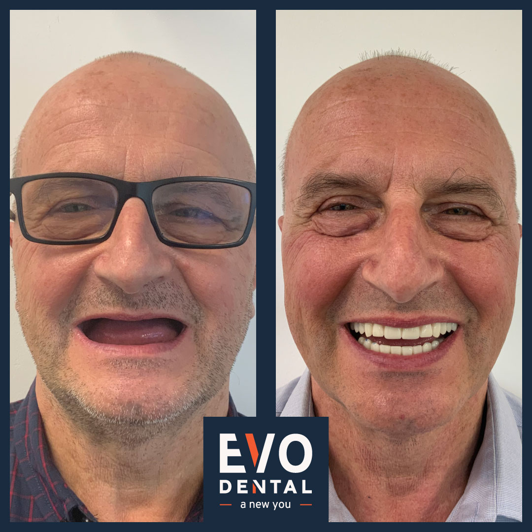 Clear difference in smile after dental implants