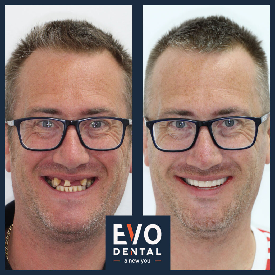Before and after images of dental implants with natural appearance
