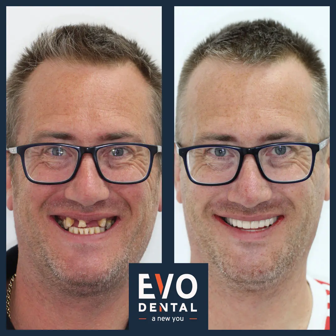 Dental implants before and after of man - Evo Dental