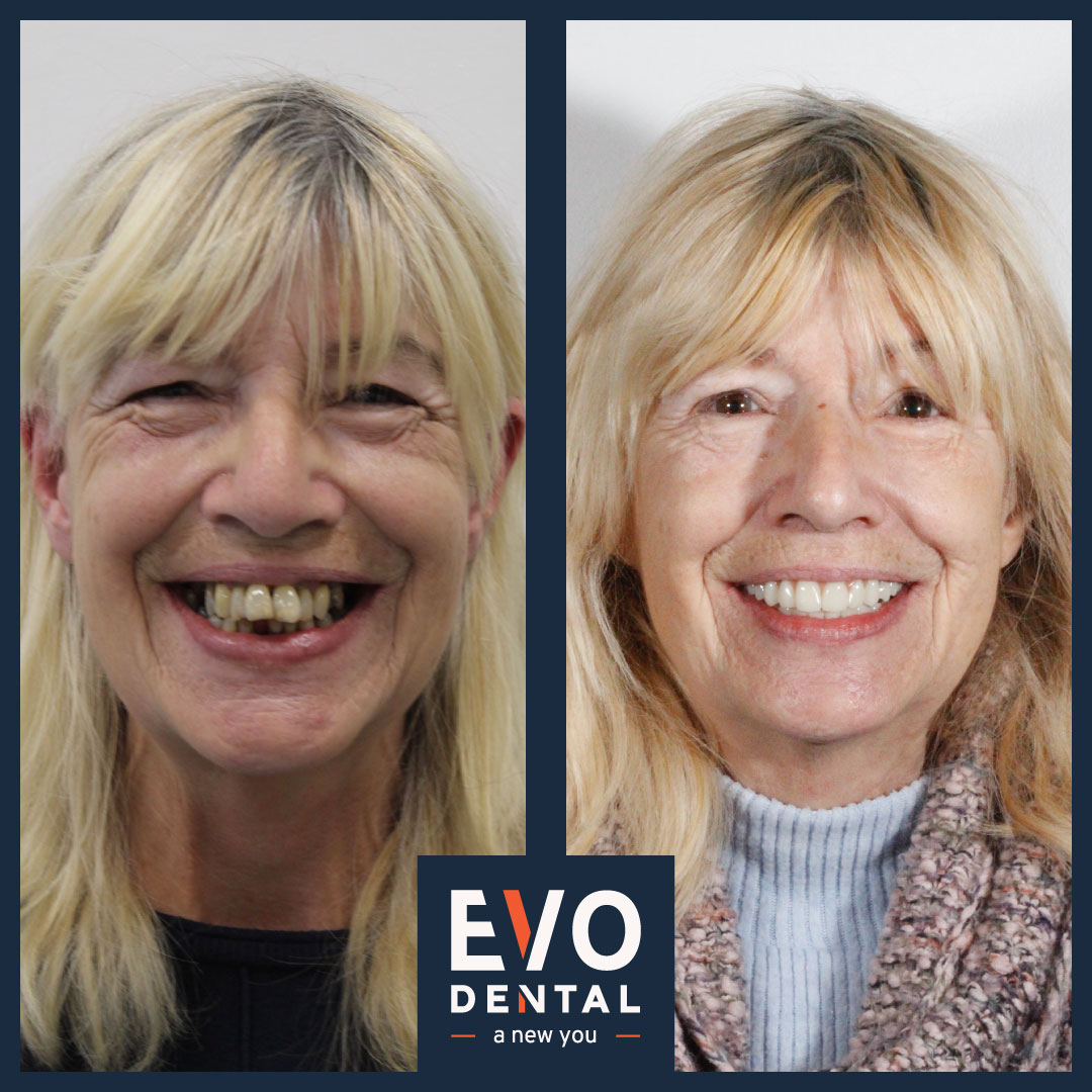 Before and after dental implants with enhanced bite and alignment