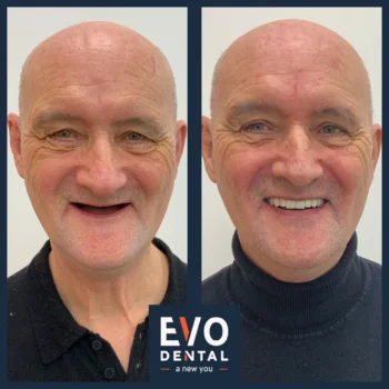 Dental implant before and after - Evo Dental Martin