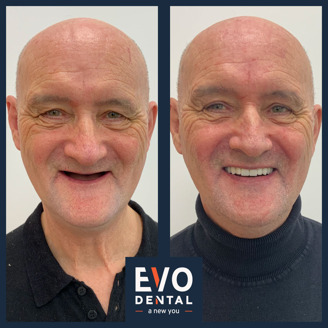 Patient's teeth before and after dental implant restoration