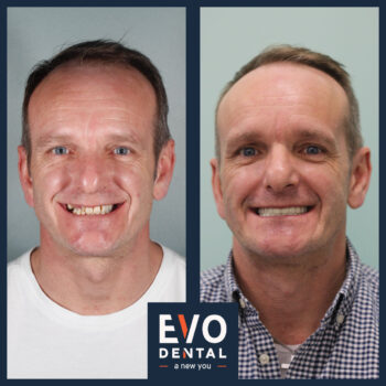 Before and after of dental implant procedure with stunning results