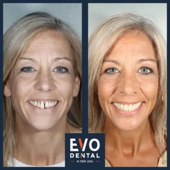 Smile in a day before and after - EVO Dental Nicola