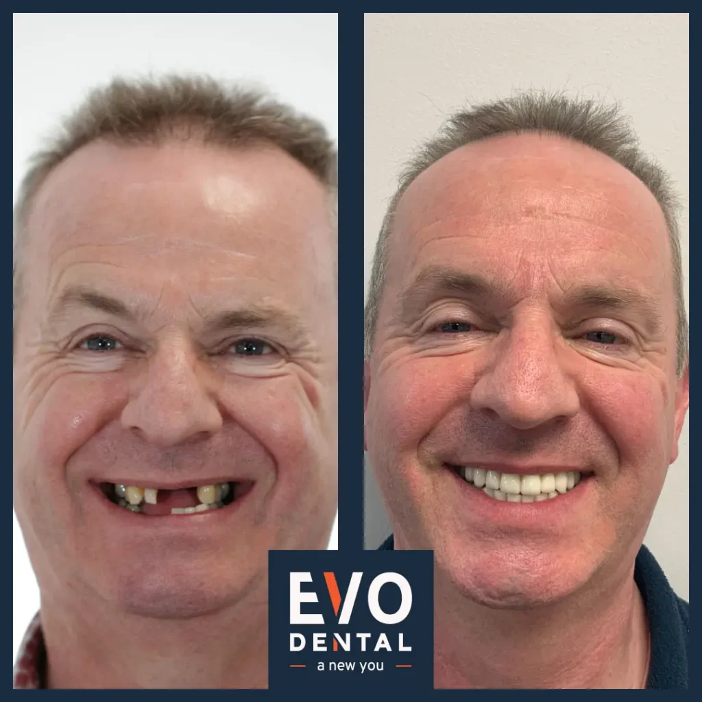 Dental implants before and after - Evo Dental