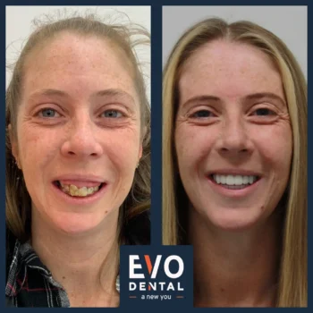 Dental implant before and after - Evo Dental Rachel